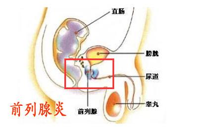 运城男科前列腺专家介绍:前列腺治疗方法！