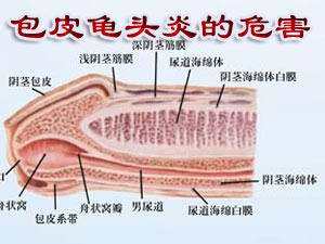 运城包皮龟头炎治疗