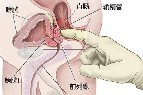 运城前列腺炎是前列腺癌的前兆吗?